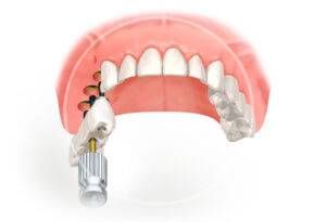 adgezivnoe protezirovanie zubov