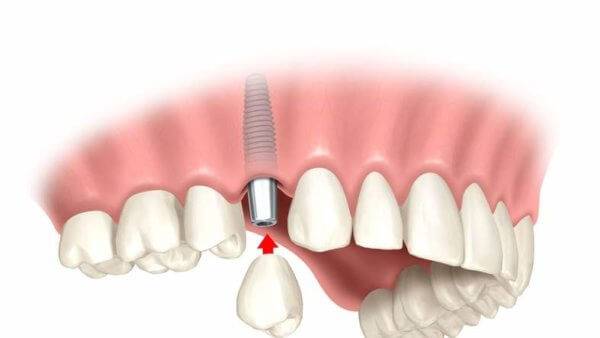 csm zahn implantat behandlung b228d697a9