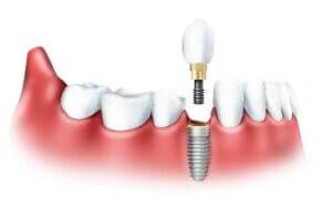 implantaciya zubov k