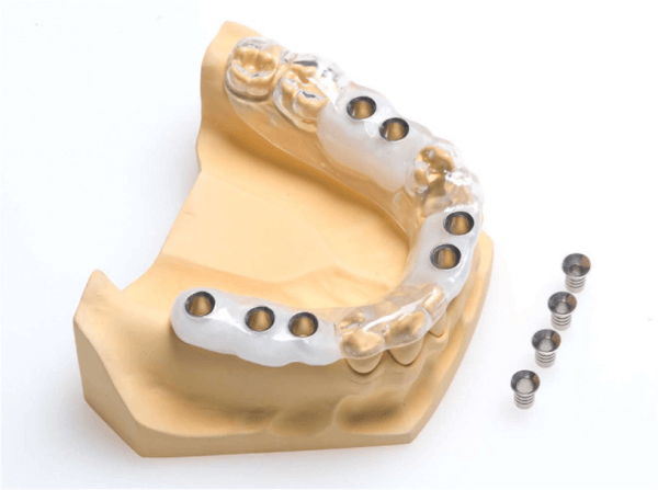 1505474462 hirurgicheskie shablony dlya implantaczii zubov