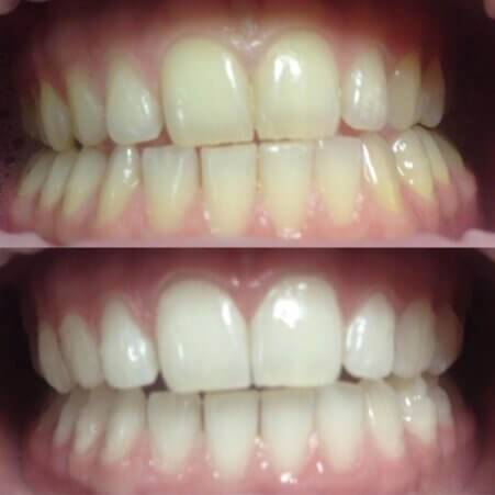 otbelivanie zubov magic smile profchistka zubov 5
